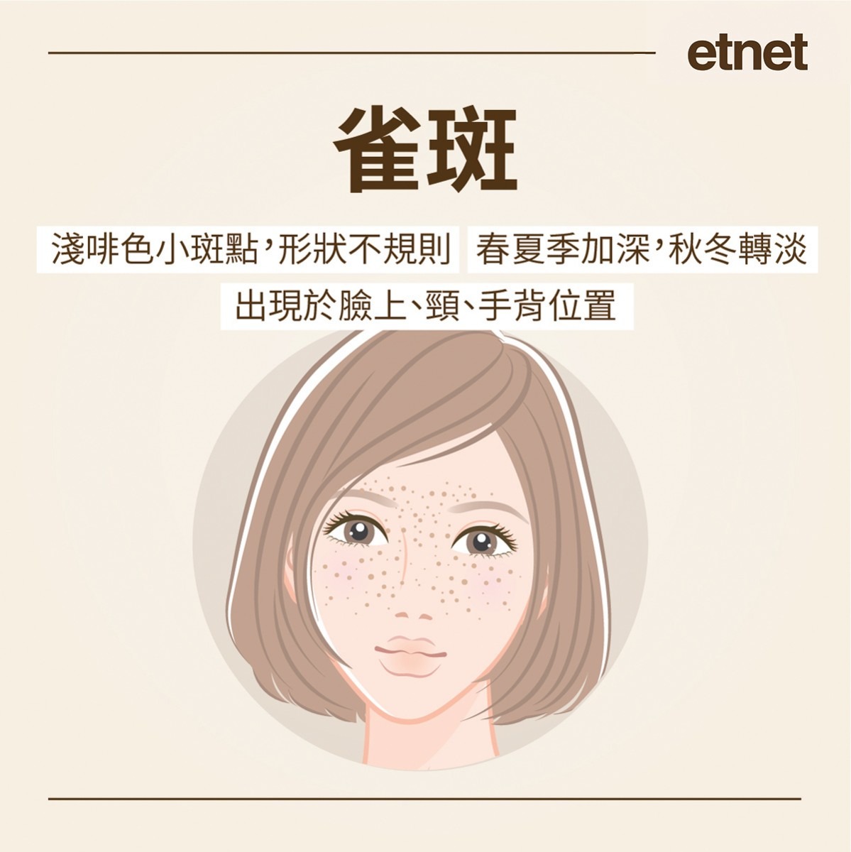 (网上图片) 黄褐斑:又称贺尔蒙斑,蝴蝶斑,妊娠斑,肝斑等,常见於亚洲的